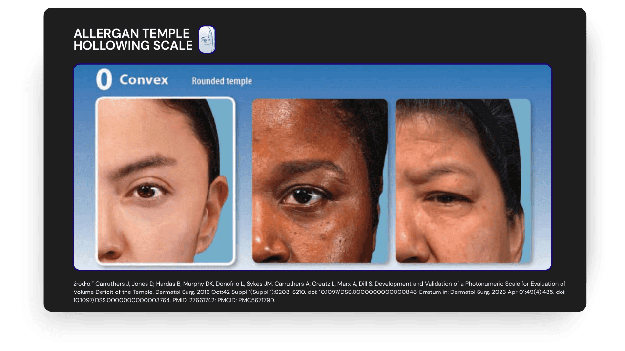 ALLERGAN TEMPLE  HOLLOWING SCALE - 0  AESTHY.png