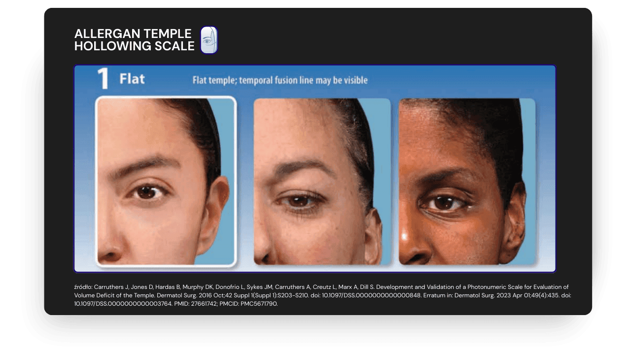 ALLERGAN TEMPLE  HOLLOWING SCALE - 1  AESTHY.png