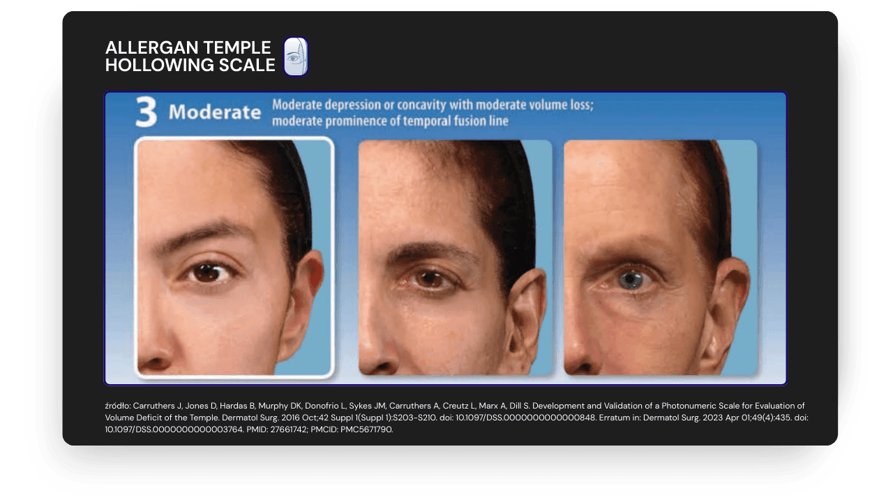 ALLERGAN TEMPLE  HOLLOWING SCALE - 3  AESTHY.png