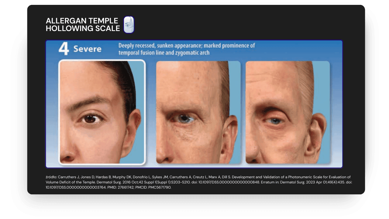 ALLERGAN TEMPLE  HOLLOWING SCALE - 4  AESTHY.png